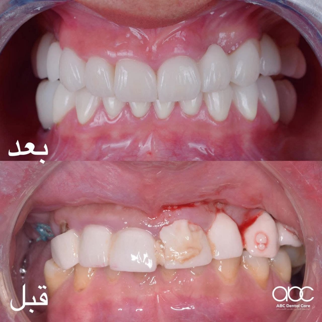حالة تجميل أسنان