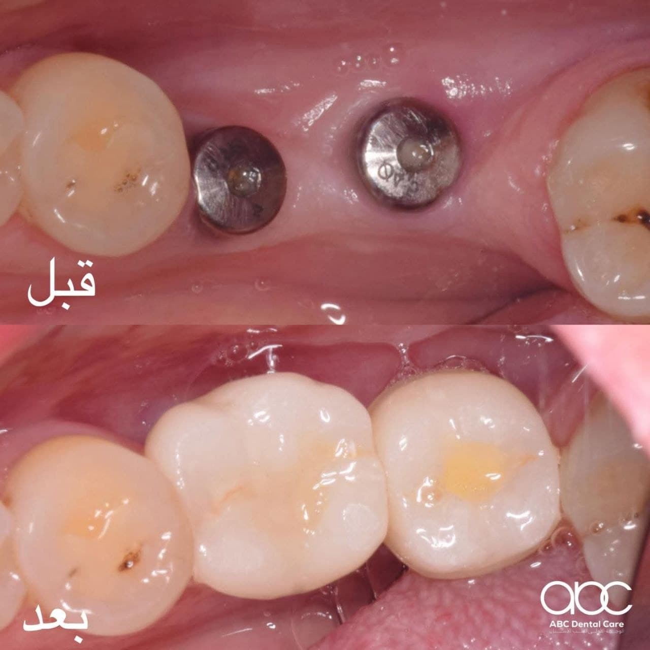حالة زراعة أسنان