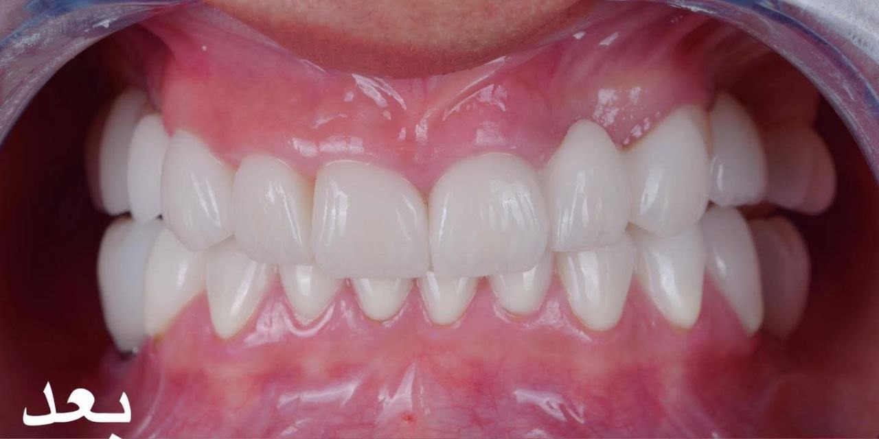 ترميم وتجميل الأسنان الأمامية — بعد